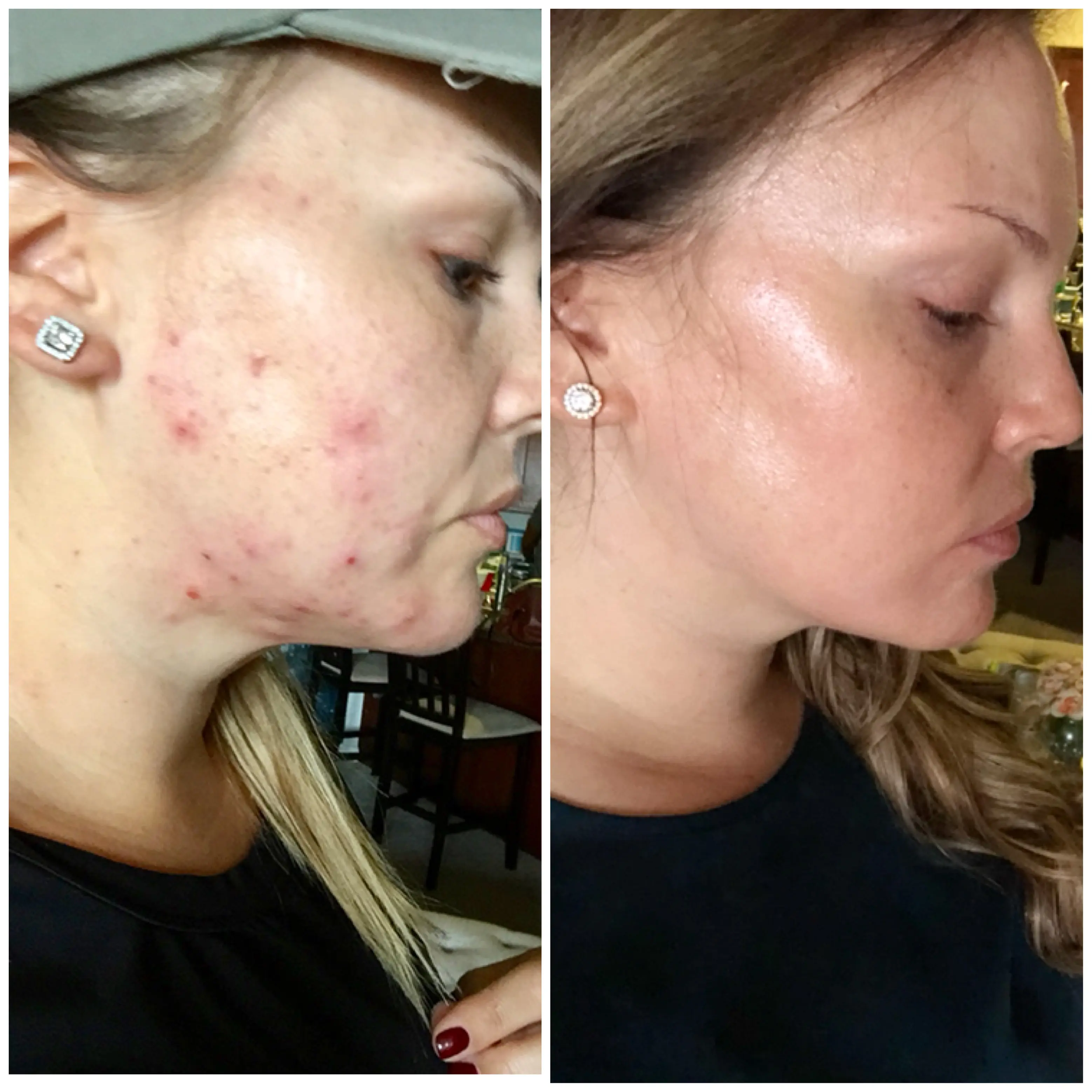 Accutane for Adult Acne: My Experience